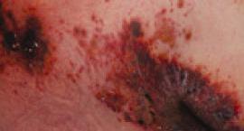 WT: Herpes zoster infection
